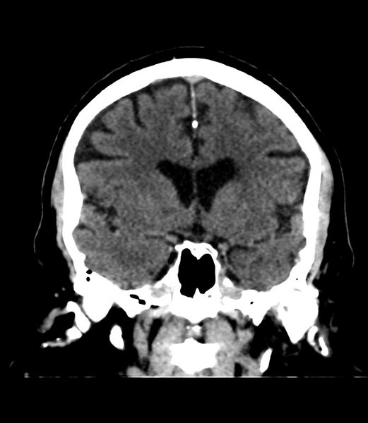 File:Cerebral dural venous sinus thrombosis (Radiopaedia 86514-102575 Coronal non-contrast 19).jpg