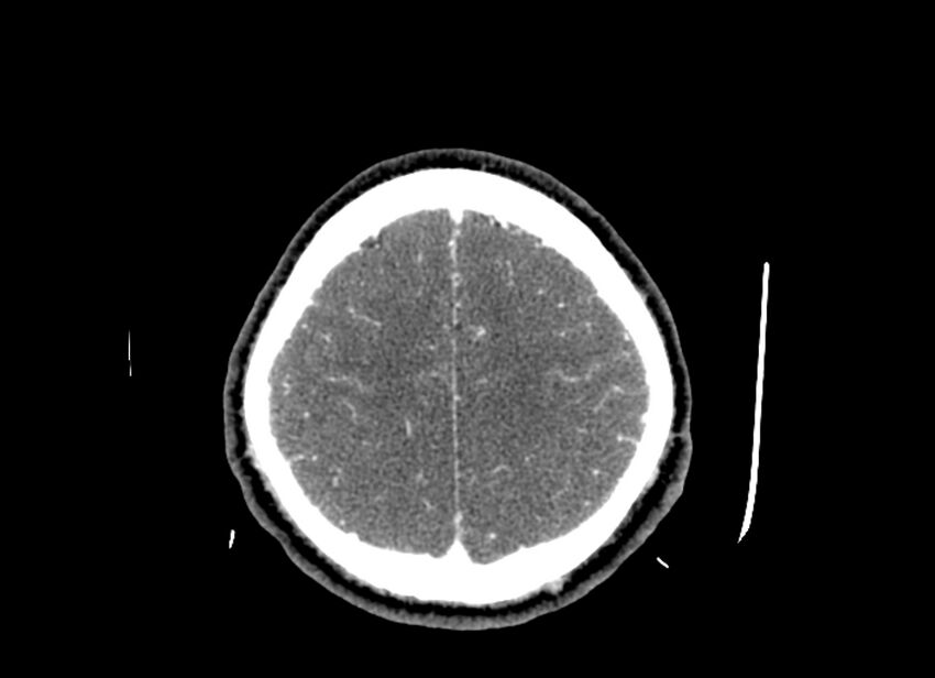 Cerebral edema (Radiopaedia 82519-96661 B 15).jpg