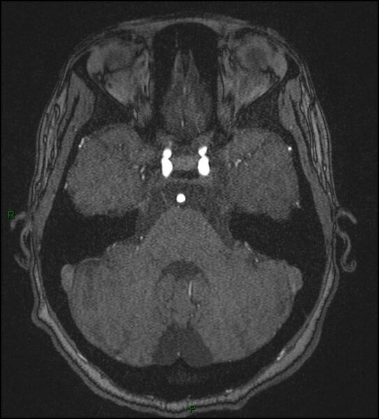 File:Cerebral fat embolism (Radiopaedia 35022-36525 Axial TOF 54).jpg