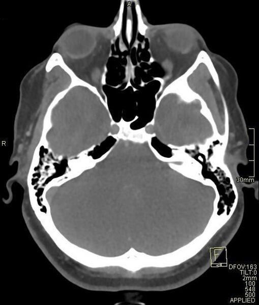 File:Cerebral venous sinus thrombosis (Radiopaedia 91329-108965 Axial venogram 24).jpg