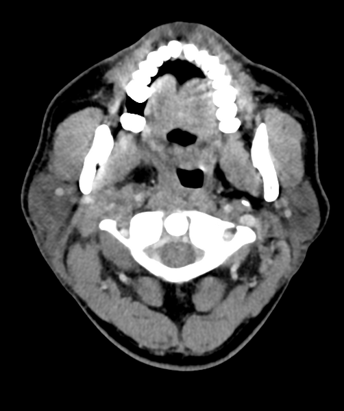 File:Cervical abscess (Radiopaedia 43725-47184 A 17).png