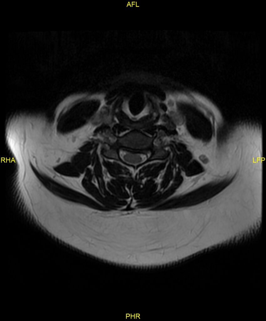 Cervical disc protrusion (Radiopaedia 87147-103415 Axial T2 27).jpg