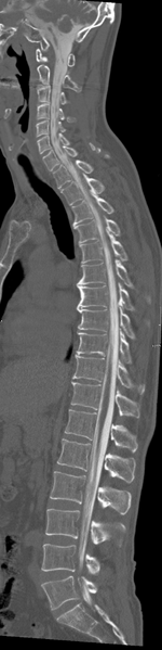 File:Cervical dural CSF leak on MRI and CT treated by blood patch (Radiopaedia 49748-54996 A 11).png