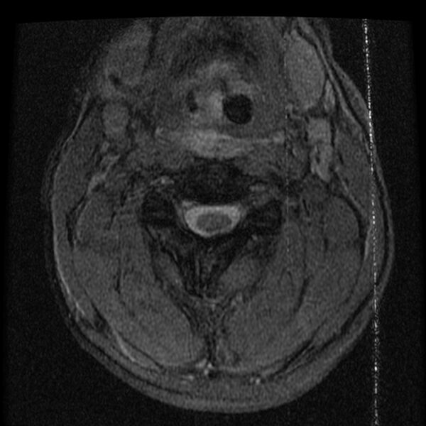 File:Cervical flexion teardrop fracture with cord hemorrhage (Radiopaedia 32497-33455 Axial Gradient Echo 8).jpg