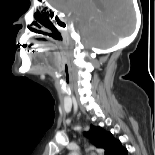 File:Cervical lymphadenopathy- cause unknown (Radiopaedia 22420-22457 D 16).jpg
