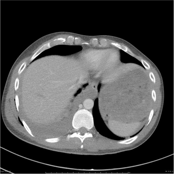 File:Chest and abdomen multi-trauma (Radiopaedia 26294-26426 bone window 13).jpg