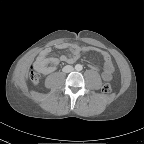 File:Chest and abdomen multi-trauma (Radiopaedia 26294-26426 bone window 53).jpg