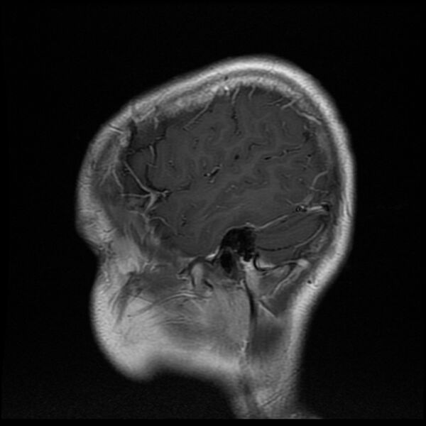 File:Chiasmatic-hypothalamic juvenile pilocytic astrocytoma (Radiopaedia 78533-91236 Sagittal T1 C+ 4).jpg