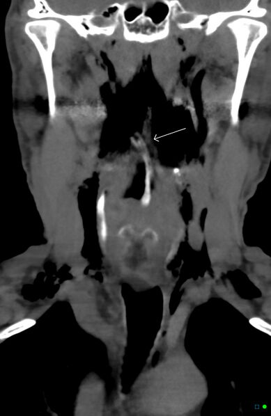 File:Chicken bone (fibula) perforation of the pharynx (Radiopaedia 21332-21261 C 1).jpg