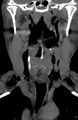 Chicken bone (fibula) perforation of the pharynx (Radiopaedia 21332-21261 C 1).jpg