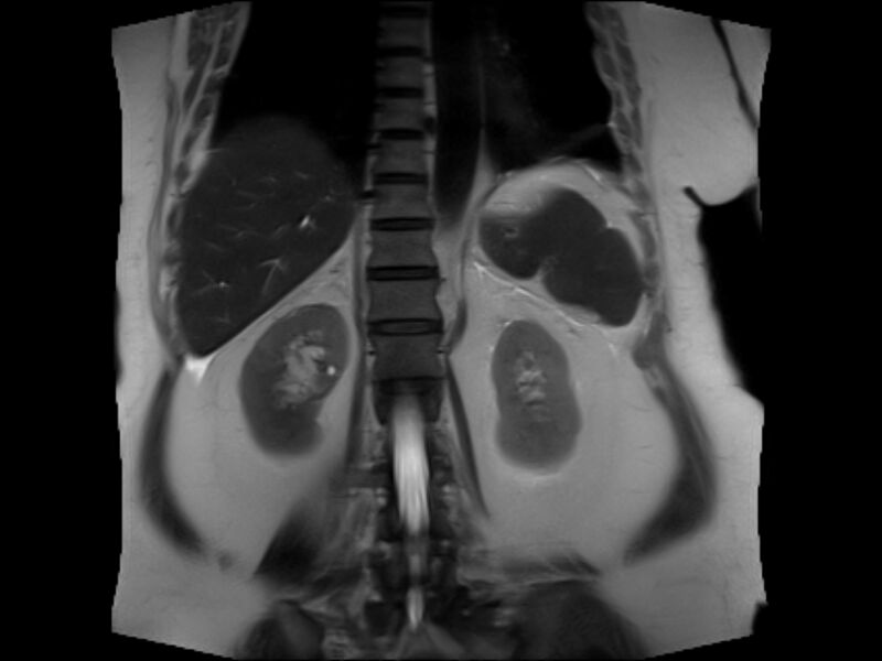 File:Choledocholithiasis causing intrahepatic biliary duct dilation (Radiopaedia 39908-42369 Coronal T2 19).jpg