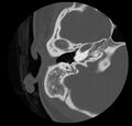 Cholesteatoma (Radiopaedia 20296-20217 bone window 21).jpg