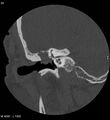 Cholesteatoma (Radiopaedia 5467-7197 Coronal bone window 9).jpg