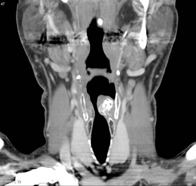 File:Chondrosarcoma - larynx (Radiopaedia 4588-6698 B 3).jpg
