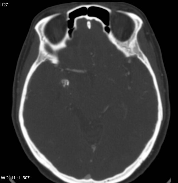 File:Chondrosarcoma - sphenoid wing (Radiopaedia 5421-7174 Axial bone window 9).jpg
