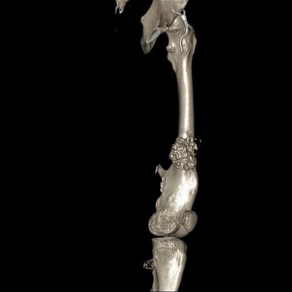 File:Chondrosarcoma arising from exostosis (Radiopaedia 59996-67507 3D Reconstruction 9).jpg