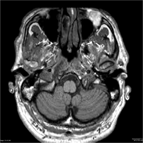 File:Chondrosarcoma of skull base- grade II (Radiopaedia 40948-43654 Axial T1 13).jpg
