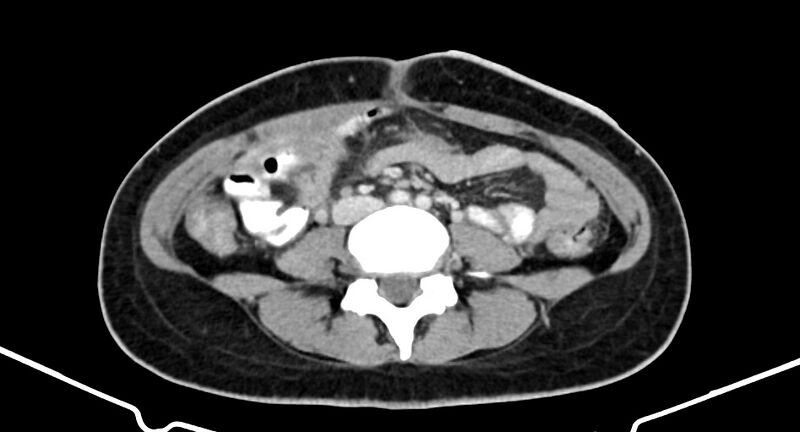 File:Choriocarcinoma liver metastases (Radiopaedia 74768-85766 A 128).jpg