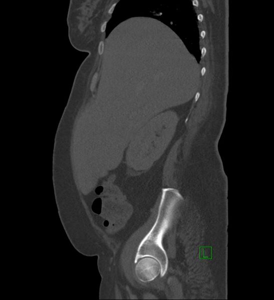 File:Chromophobe renal cell carcinoma (Radiopaedia 84239-99519 Sagittal bone window 82).jpg