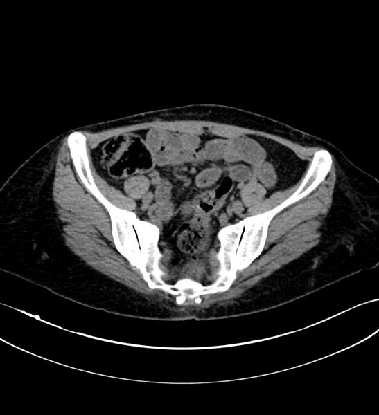 File:Chromophobe renal cell carcinoma (Radiopaedia 84290-99582 Axial non-contrast 115).jpg