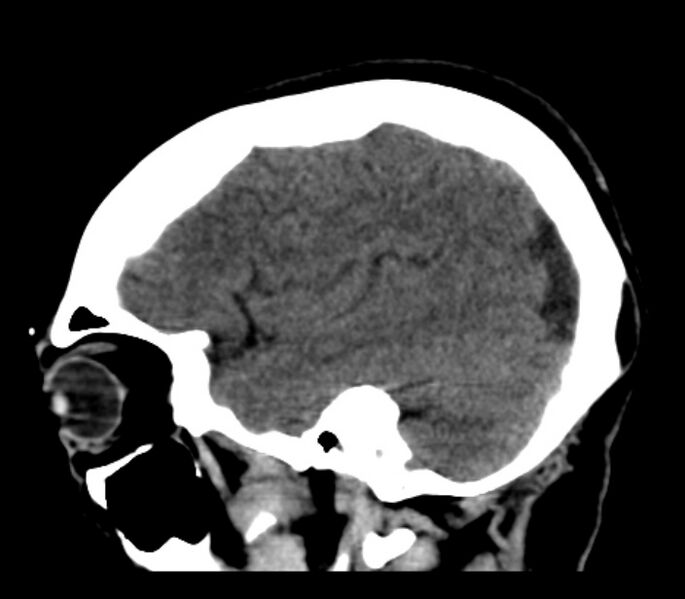 File:Chronic bilateral occipital lobe infarcts (Radiopaedia 31276-31996 C 30).jpg