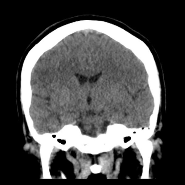File:Chronic bilateral occipital lobe infarcts (Radiopaedia 31276-31996 Coronal non-contrast 25).jpg