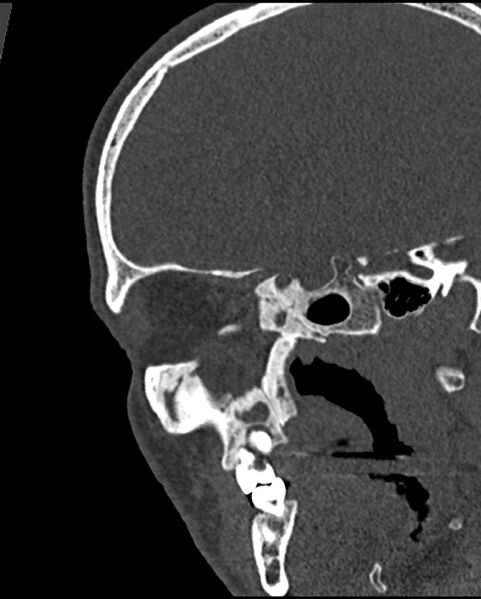 File:Chronic maxillary sinusitis caused by a foreign body (Radiopaedia 58521-65676 Sagittal bone window 49).jpg