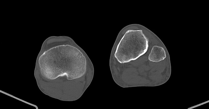 File:Chronic osteomyelitis (with sequestrum) (Radiopaedia 74813-85822 Axial non-contrast 200).jpg