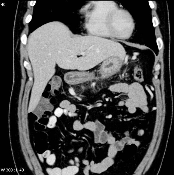 File:Chronic pancreatitis and pseudocysts (Radiopaedia 6724-7935 E 1).jpg