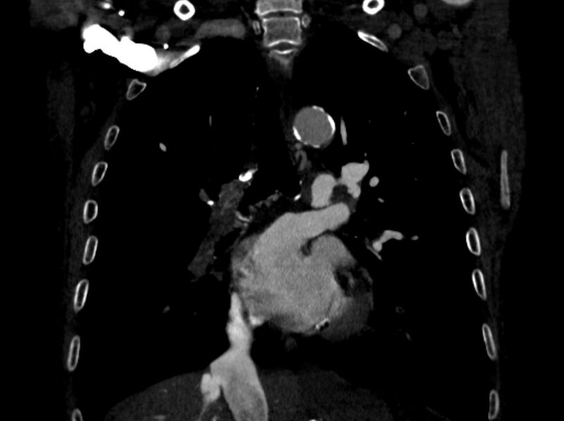File:Chronic pulmonary embolism (Radiopaedia 91241-108843 A 57).jpg
