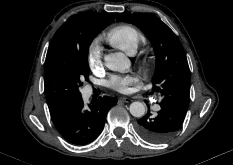File:Chronic pulmonary embolism with bubbly consolidation (Radiopaedia 91248-108850 C+ arterial phase 82).jpg