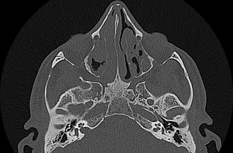 File:Chronic rhinosinusitis (Radiopaedia 65079-74075 Axial bone window 39).jpg