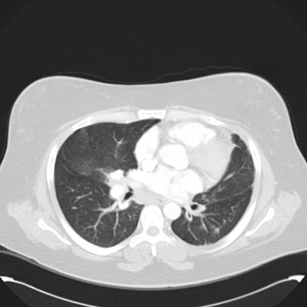 File:Chronic thromboembolic pulmonary hypertension (CTEPH) (Radiopaedia 74597-85531 Axial lung window 27).jpg