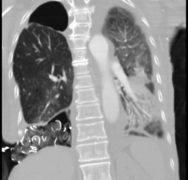 File:Clagett thoracotomy with bronchopleural fistula (Radiopaedia 29192-29587 Coronal lung window 10).jpg