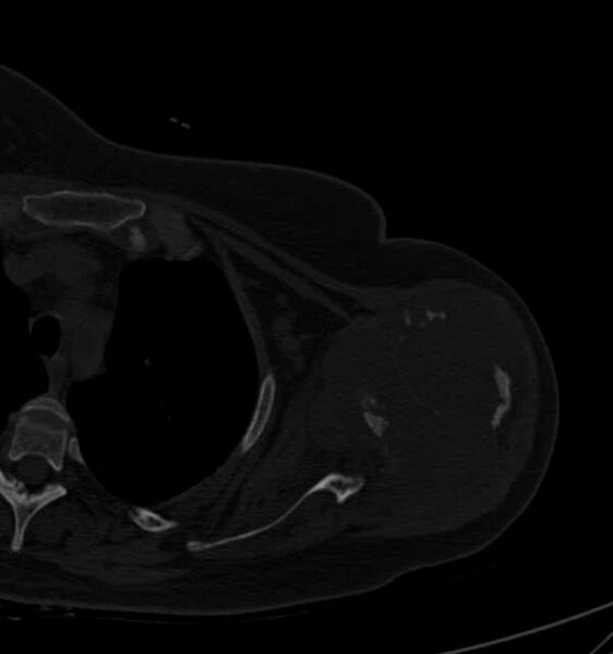 File:Clear cell chondrosarcoma - humerus (Radiopaedia 63104-71612 Axial bone window 46).jpg