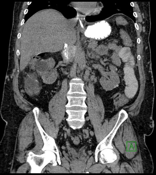 File:Closed-loop small bowel obstruction-internal hernia (Radiopaedia 78439-91096 Coronal non-contrast 60).jpg