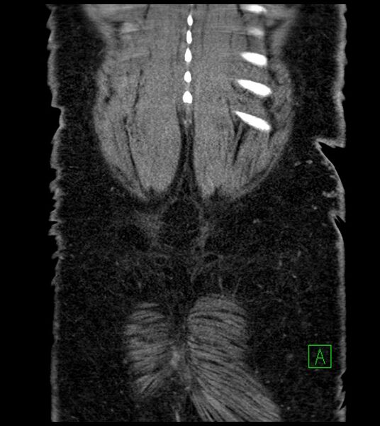 File:Closed-loop small bowel obstruction-internal hernia (Radiopaedia 78439-91096 Coronal non-contrast 94).jpg