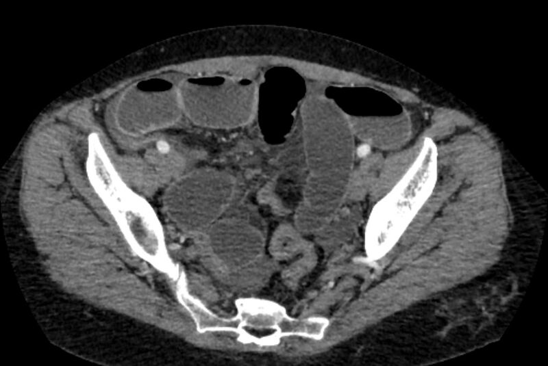 File:Closed loop small bowel obstruction (Radiopaedia 71211-81508 A 132).jpg