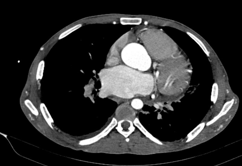 File:Coarctation of aorta with aortic valve stenosis (Radiopaedia 70463-80574 A 111).jpg