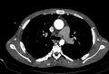 Coarctation of aorta with aortic valve stenosis (Radiopaedia 70463-80574 A 62).jpg