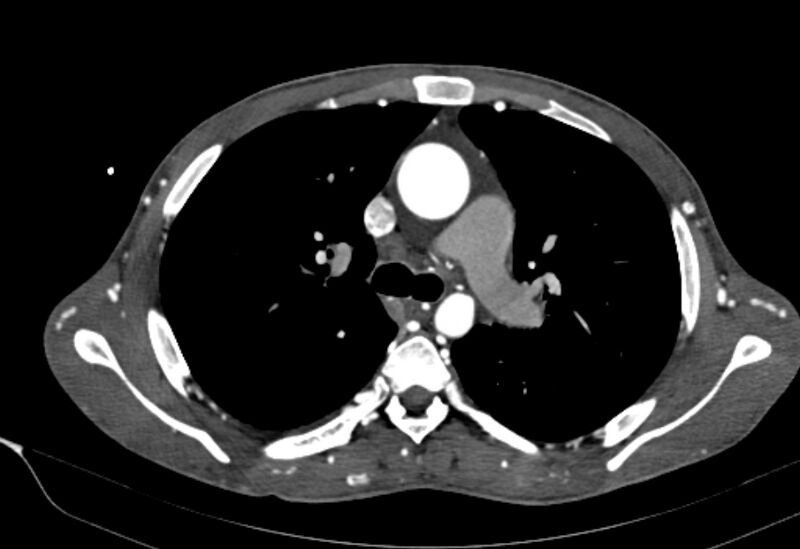 File:Coarctation of aorta with aortic valve stenosis (Radiopaedia 70463-80574 A 62).jpg