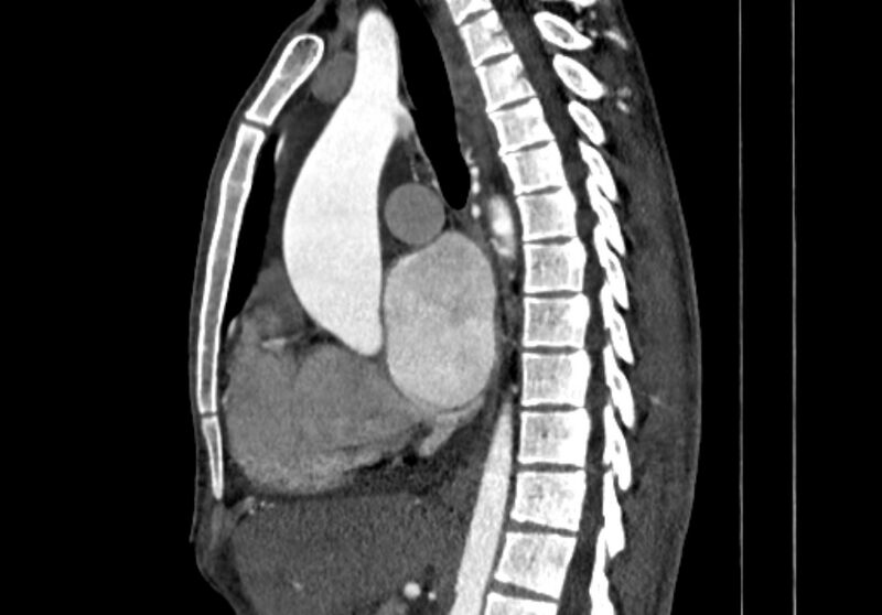 File:Coarctation of aorta with aortic valve stenosis (Radiopaedia 70463-80574 B 57).jpg