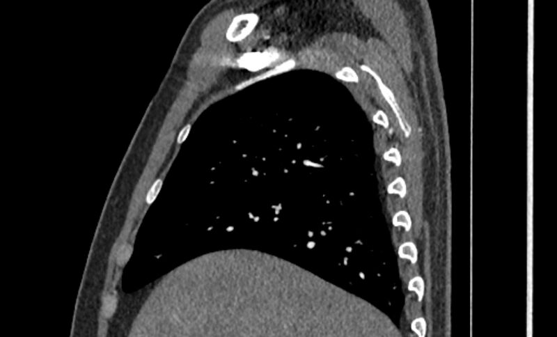 File:Coarctation of the aorta (Radiopaedia 53363-59343 B 4).jpg