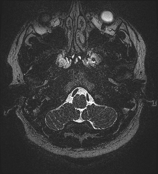 File:Cochlear incomplete partition type III associated with hypothalamic hamartoma (Radiopaedia 88756-105498 Axial T2 21).jpg