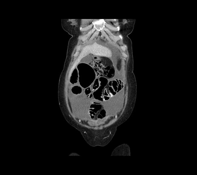 File:Cocoon abdomen with possible tubo-ovarian abscess (Radiopaedia 46235-50636 B 8).jpg