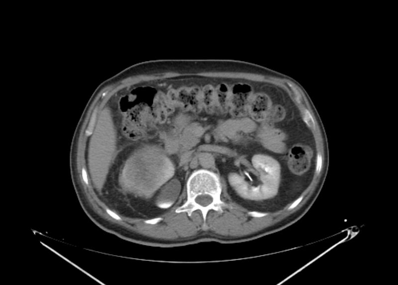 File:Colon cancer mimicking renal cell carcinoma (Radiopaedia 28986-29335 Axial C+ delayed 27).jpg