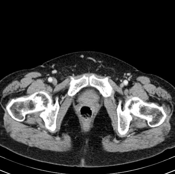 File:Colon carcinoma with hepatic metastases (Radiopaedia 29477-29961 A 115).jpg