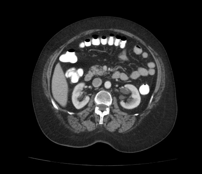File:Colonic diverticulosis (Radiopaedia 22934-22957 A 29).jpg