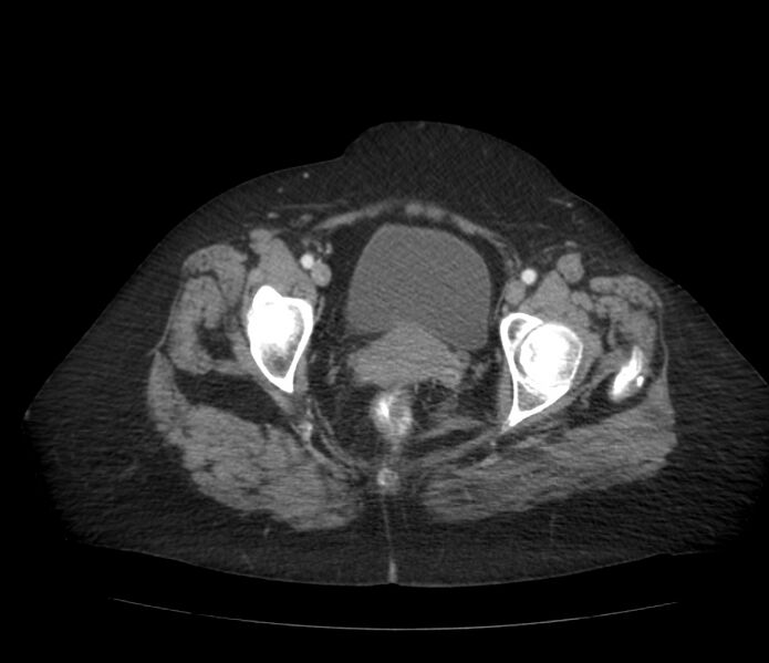 File:Colonic diverticulosis (Radiopaedia 22934-22957 A 69).jpg