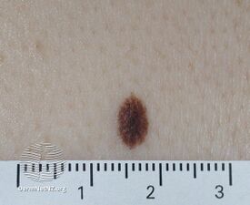 Junctional naevus (DermNet NZ lesions-mole2).jpg